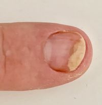 Fingernagelentzündung 1