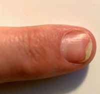 Fingernagelentzündung 4