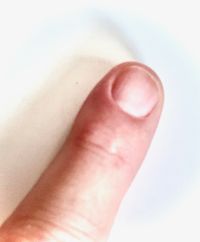 Fingernagelentzündung 5